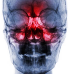 ASCO Breakthrough 2024 presents a Phase 3 trial that shows radiation alone matches chemoradiation for low-risk nasopharyngeal cancer.