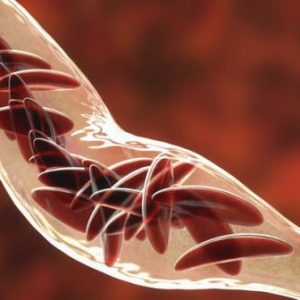 sickle cells in a blood vein