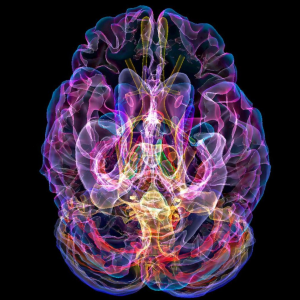 A colored MRI scan of the brain of a patient with Alzheimer’s disease. SCIENCE PHOTO LIBRARY